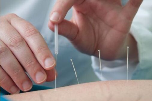 Akupunktura to metoda leczenia bólu okolicy lędźwiowej spowodowanego osteochondrozą