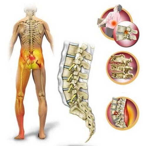 Osteochondroza kręgosłupa lędźwiowego powodująca ból w dolnej części pleców