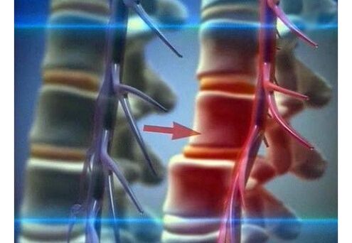 Ucisk zakończeń nerwowych w osteochondrozie lędźwiowej