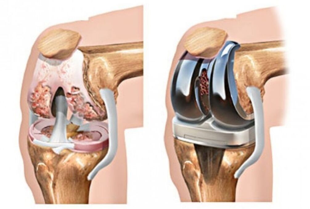 endoprotezoplastyka stawu kolanowego w przypadku artrozy