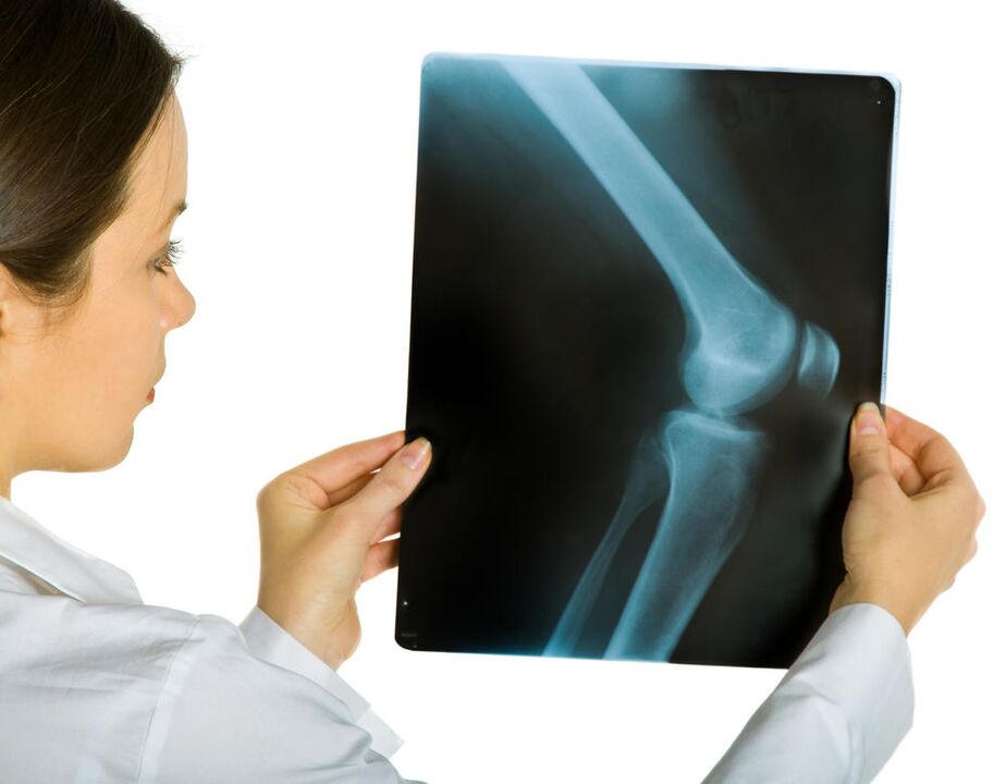 Rentgen stawu kolanowego ujawni obecność deformującej artrozy